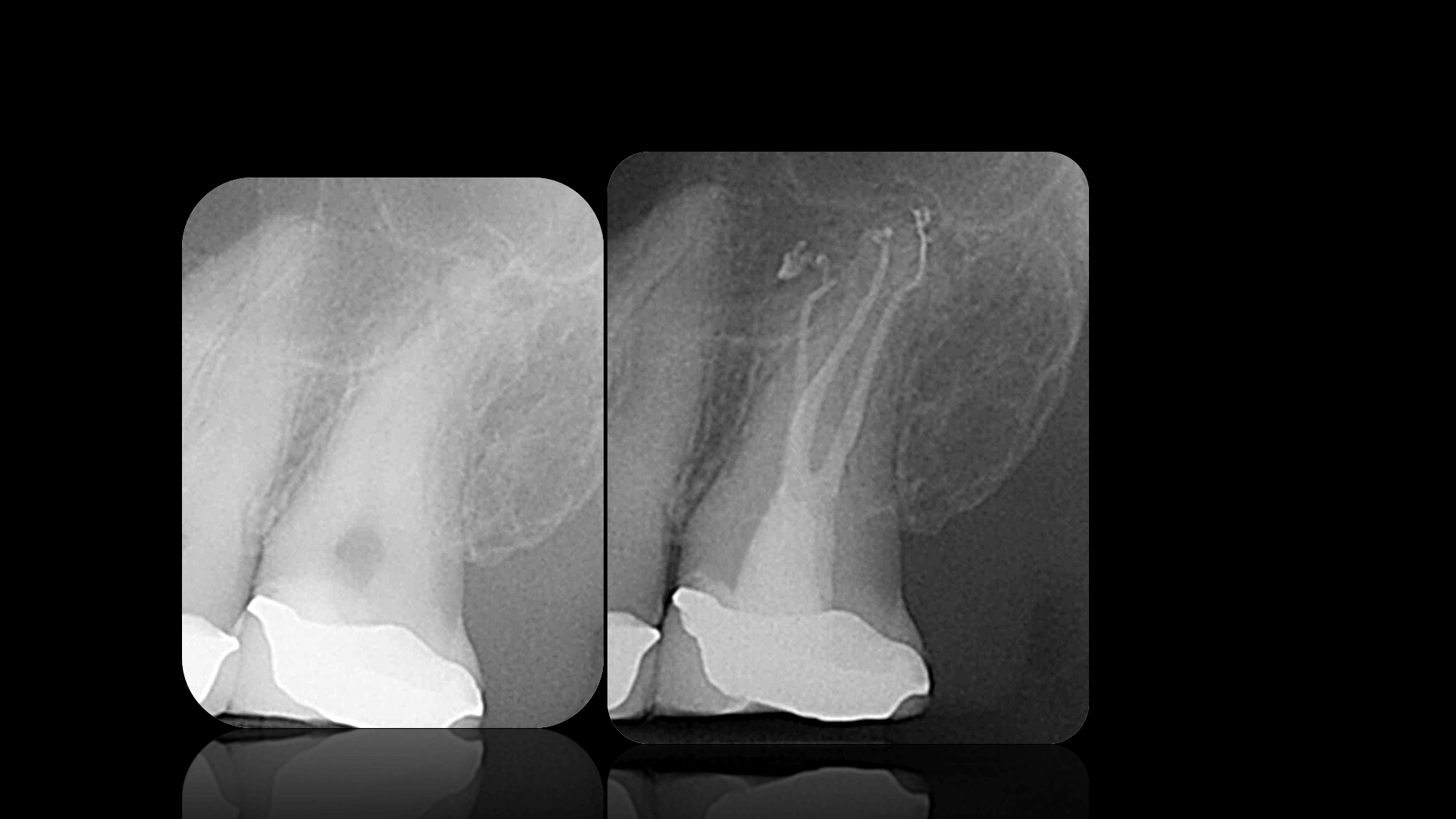 Broken Instrument Removal - Case 6
